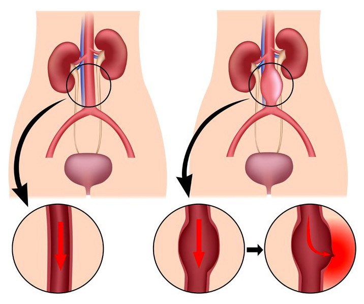 La rupture d'anévrysme : Explications