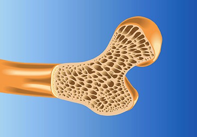 Ostéoporose : que faire pour la prévenir ?